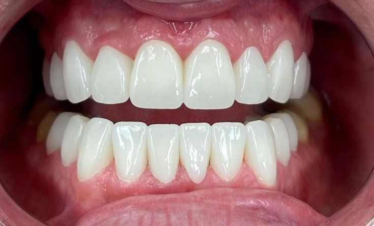 teeth after